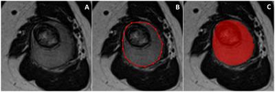 3D vs. 2D MRI radiomics in skeletal Ewing sarcoma: Feature reproducibility and preliminary machine learning analysis on neoadjuvant chemotherapy response prediction